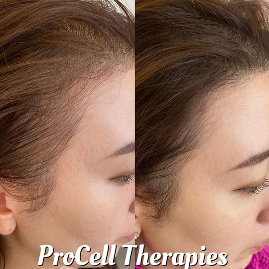 プロセル頭皮改善トリートメント - 石岡市の脱毛・エステサロンなら