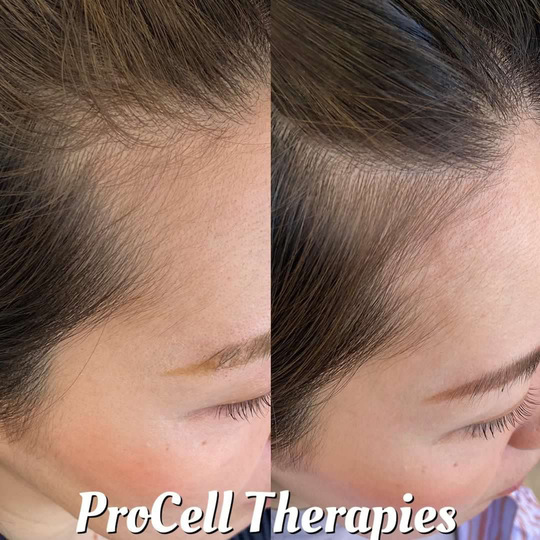 プロセルセラピーズ　2本 プロセル頭皮改善トリートメント - 石岡市の脱毛・エステサロンなら